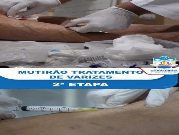 Chapadinha realiza segunda etapa do Mutirão de Varizes com atendimento especializado